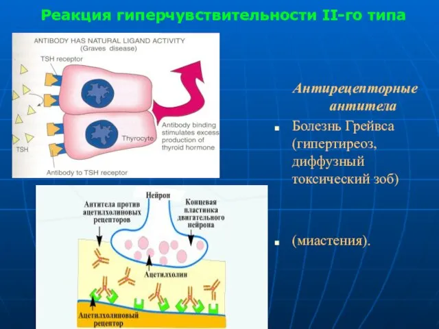 Реакция гиперчувствительности II-го типа Антирецепторные антитела Болезнь Грейвса (гипертиреоз, диффузный токсический зоб) (миастения).