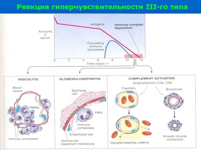 Реакция гиперчувствительности III-го типа