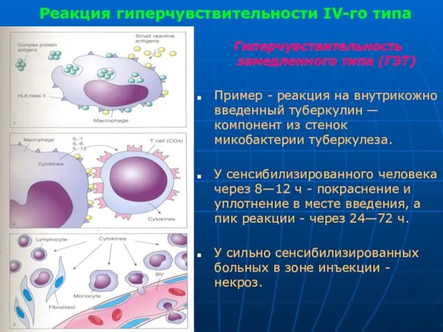 Реакция гиперчувствительности IV-го типа Гиперчувствительность замедленного типа (ГЗТ) Пример - реакция