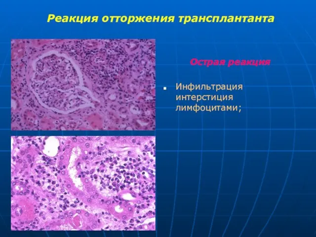 Реакция отторжения трансплантанта Острая реакция Инфильтрация интерстиция лимфоцитами;