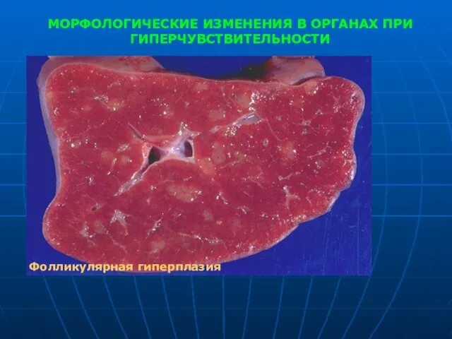 МОРФОЛОГИЧЕСКИЕ ИЗМЕНЕНИЯ В ОРГАНАХ ПРИ ГИПЕРЧУВСТВИТЕЛЬНОСТИ Фолликулярная гиперплазия