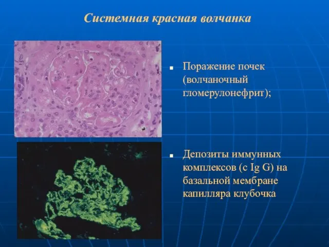 Системная красная волчанка Поражение почек (волчаночный гломерулонефрит); Депозиты иммунных комплексов (с