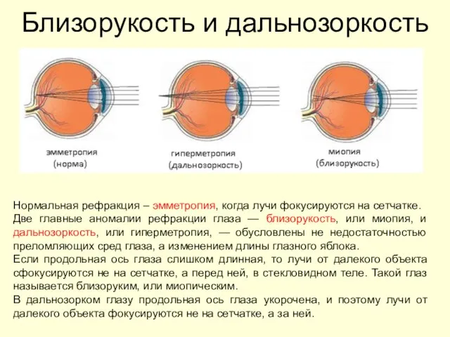 Близорукость и дальнозоркость Нормальная рефракция – эмметропия, когда лучи фокусируются на