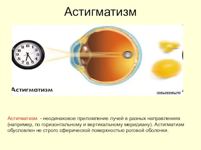 Астигматизм Астигматизм - неодинаковое преломление лучей в разных направлениях (например, по