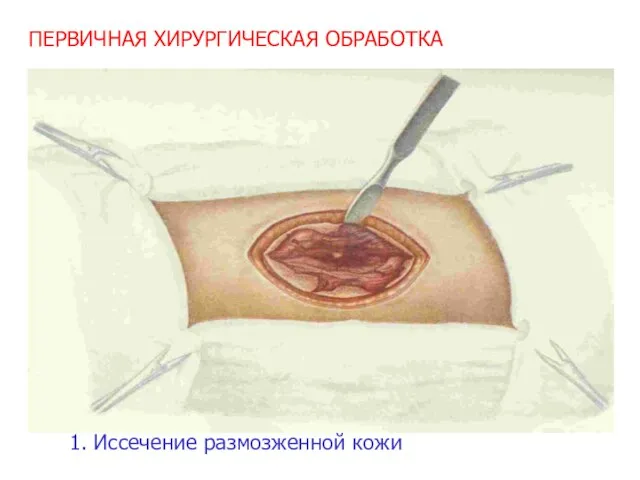 ПЕРВИЧНАЯ ХИРУРГИЧЕСКАЯ ОБРАБОТКА 1. Иссечение размозженной кожи