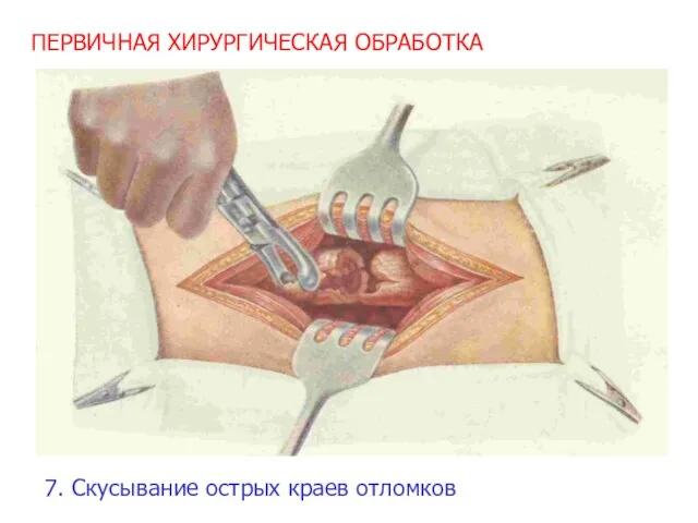 ПЕРВИЧНАЯ ХИРУРГИЧЕСКАЯ ОБРАБОТКА 7. Скусывание острых краев отломков