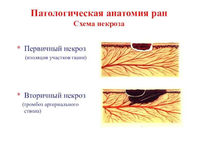 Патологическая анатомия ран Схема некроза Первичный некроз (изоляция участков ткани) Вторичный некроз (тромбоз артериального ствола)