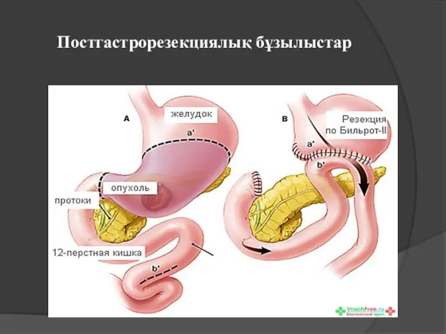 Постгастрорезекциялық бұзылыстар