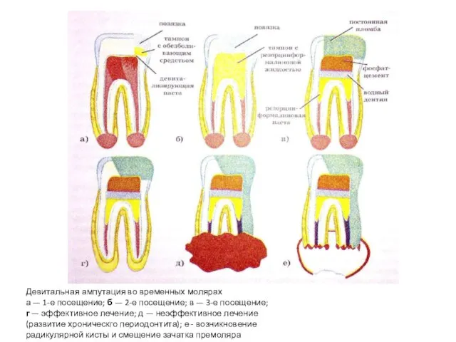 Девитальная ампутация во временных молярах а — 1-е посещение; б —