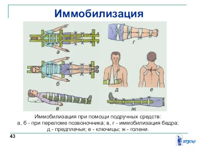 Иммобилизация Иммобилизация при помощи подручных средств: а, б - при переломе