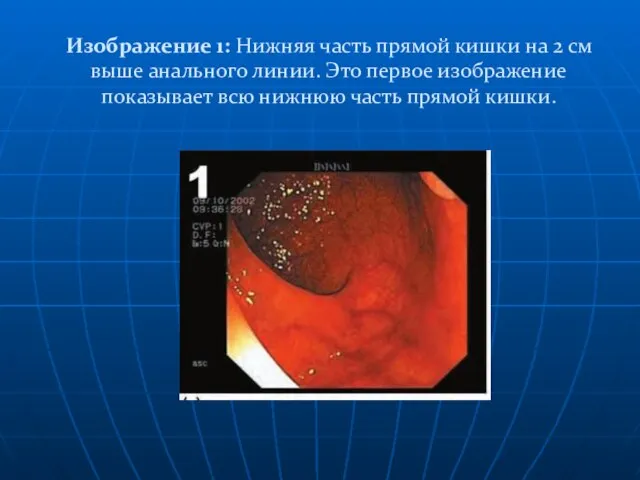 Изображение 1: Нижняя часть прямой кишки на 2 см выше анального