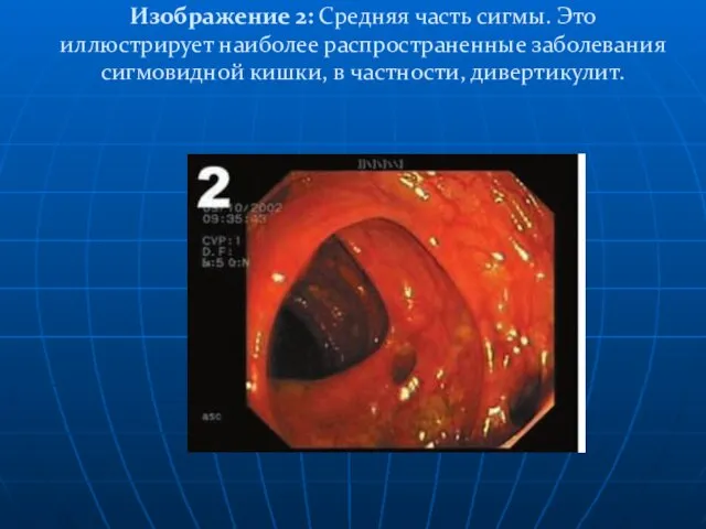 Изображение 2: Средняя часть сигмы. Это иллюстрирует наиболее распространенные заболевания сигмовидной кишки, в частности, дивертикулит.