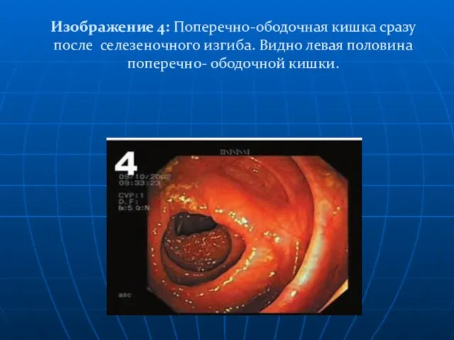 Изображение 4: Поперечно-ободочная кишка сразу после селезеночного изгиба. Видно левая половина поперечно- ободочной кишки.