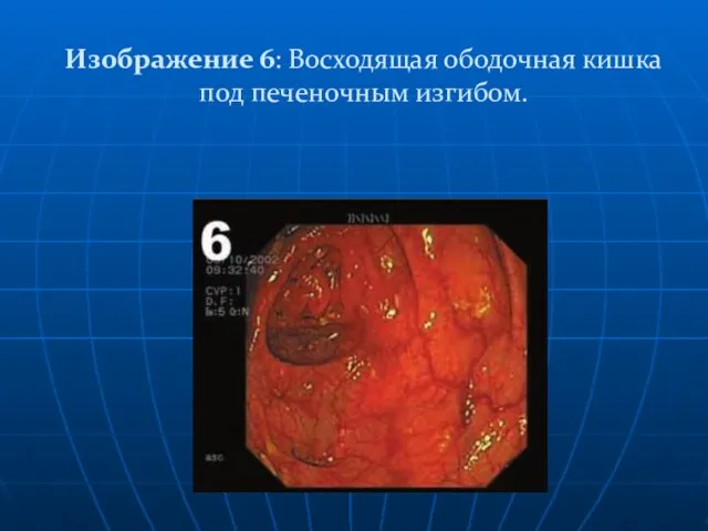 Изображение 6: Восходящая ободочная кишка под печеночным изгибом.