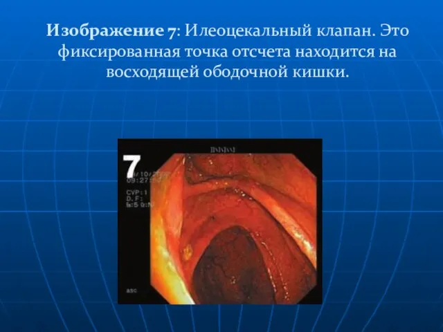 Изображение 7: Илеоцекальный клапан. Это фиксированная точка отсчета находится на восходящей ободочной кишки.