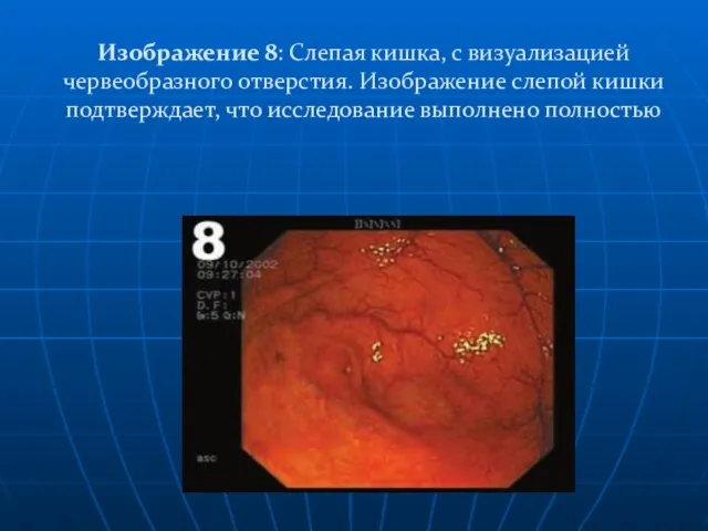 Изображение 8: Слепая кишка, с визуализацией червеобразного отверстия. Изображение слепой кишки подтверждает, что исследование выполнено полностью