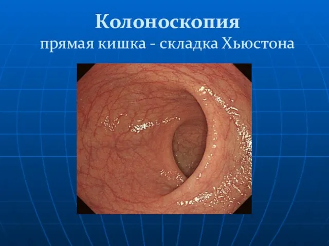 Колоноскопия прямая кишка - складка Хьюстона