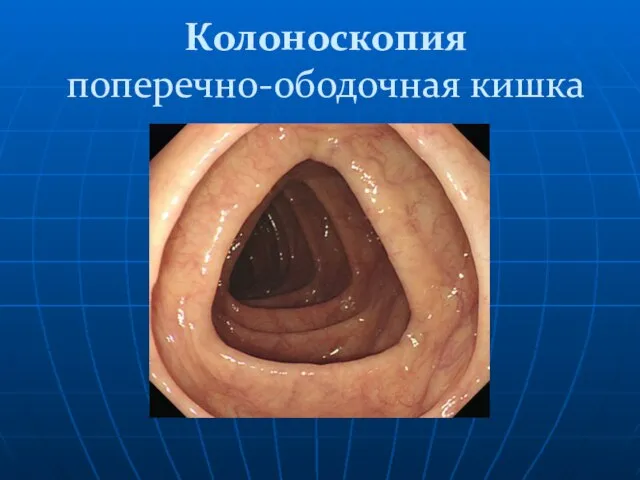 Колоноскопия поперечно-ободочная кишка