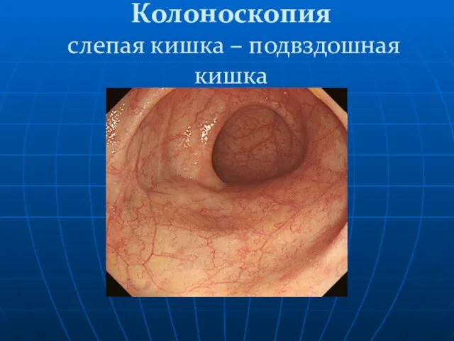 Колоноскопия слепая кишка – подвздошная кишка