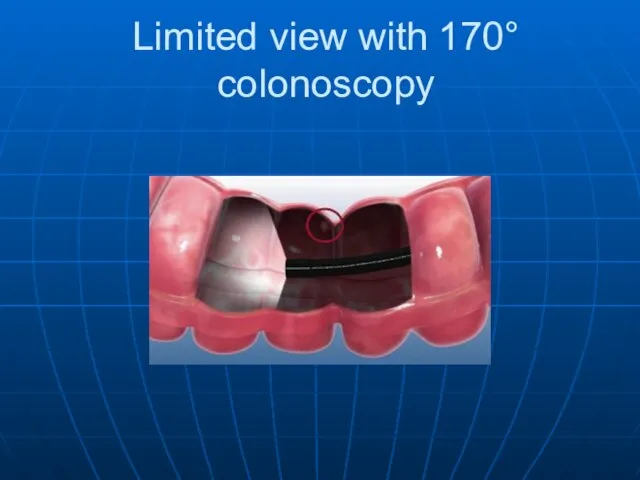 Limited view with 170° colonoscopy