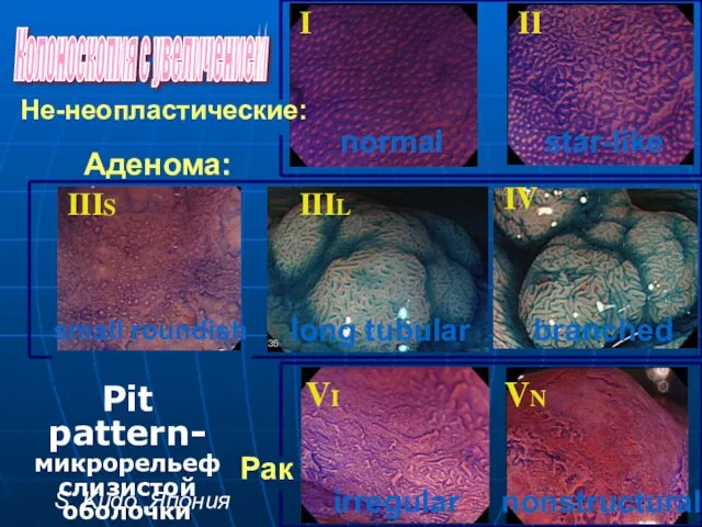 ! Не-неопластические: Pit pattern- микрорельеф слизистой оболочки I II IIIL IIIS