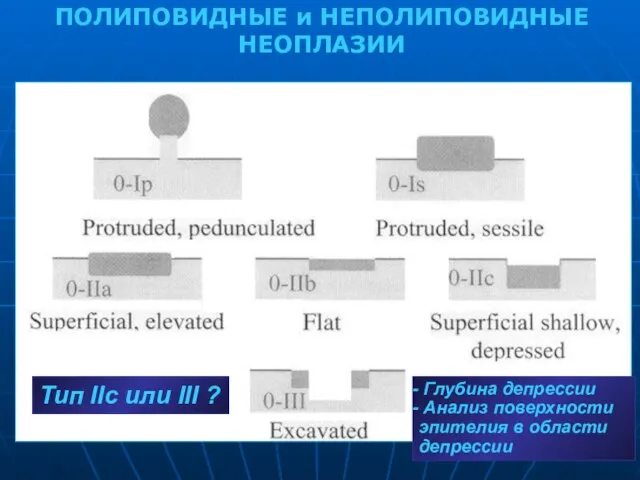 Глубина депрессии Анализ поверхности эпителия в области депрессии ПОЛИПОВИДНЫЕ и НЕПОЛИПОВИДНЫЕ