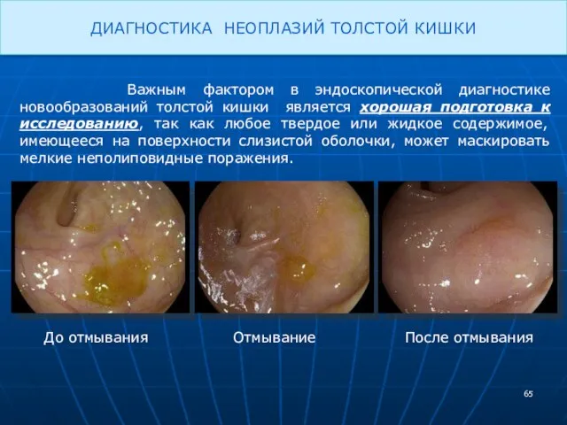 ДИАГНОСТИКА НЕОПЛАЗИЙ ТОЛСТОЙ КИШКИ Важным фактором в эндоскопической диагностике новообразований толстой