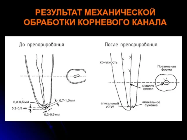 РЕЗУЛЬТАТ МЕХАНИЧЕСКОЙ ОБРАБОТКИ КОРНЕВОГО КАНАЛА