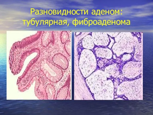 Разновидности аденом: тубулярная, фиброаденома