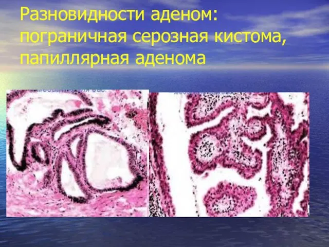 Разновидности аденом: пограничная серозная кистома, папиллярная аденома
