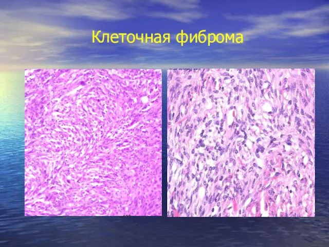 Клеточная фиброма
