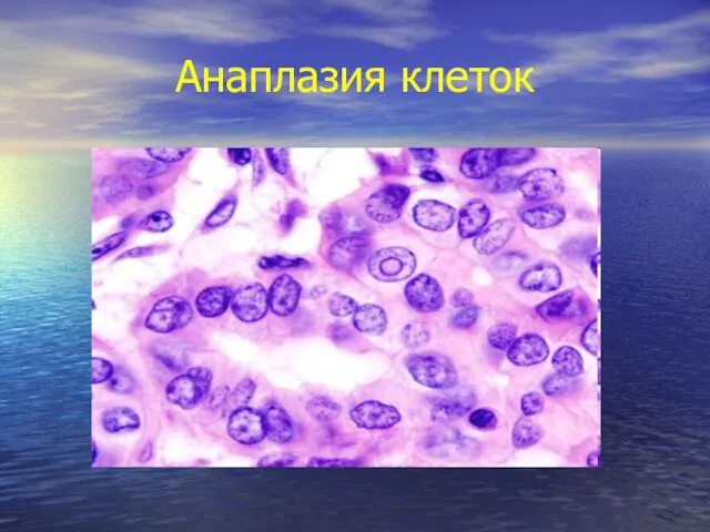 Анаплазия клеток