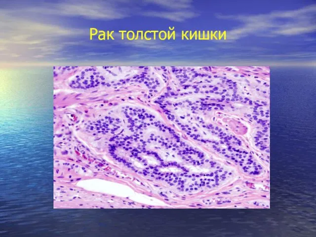 Рак толстой кишки