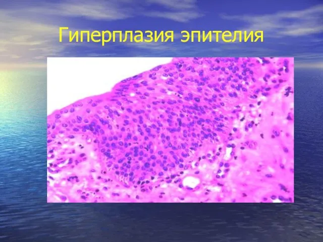 Гиперплазия эпителия