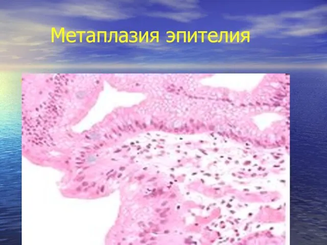 Метаплазия эпителия Метаплазия эпителия