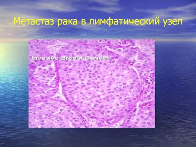 Метастаз рака в лимфатический узел