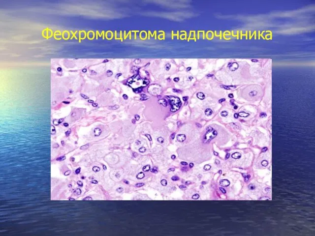 Феохромоцитома надпочечника