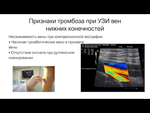 Признаки тромбоза при УЗИ вен нижних конечностей Несжимаемость вены при компрессионной