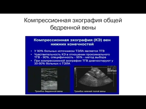 Компрессионная эхография общей бедренной вены