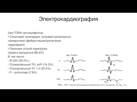 Электрокардиография (при ТЭЛА неспецифична) • Синусовая тахикардия, суправентрикулярные тахиаритмии (фибрилляция/трепетание предсердий).