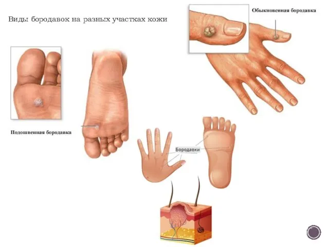 Виды бородавок на разных участках кожи