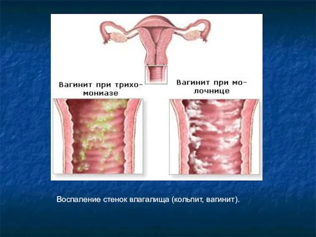 Воспаление стенок влагалища (кольпит, вагинит).