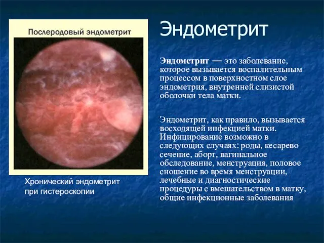 Эндометрит Эндометрит — это заболевание, которое вызывается воспалительным процессом в поверхностном