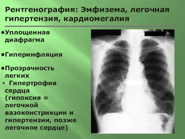 Рентгенография: Эмфизема, легочная гипертензия, кардиомегалия Уплощенная диафрагма Гиперинфляция Прозрачность легких Гипертрофия