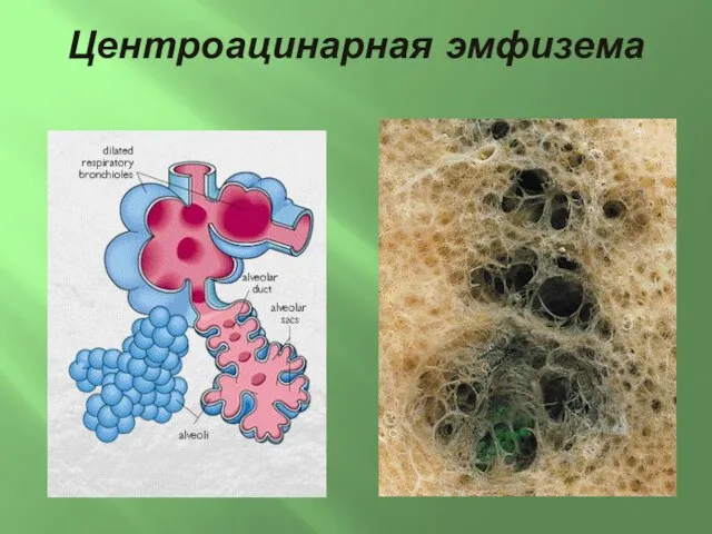 Центроацинарная эмфизема