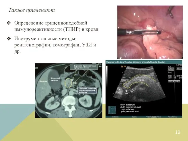 Определение трипсиноподобной иммунореактивности (ТПИР) в крови Инструментальные методы: рентгенографии, томографии, УЗИ и др. Также применяют