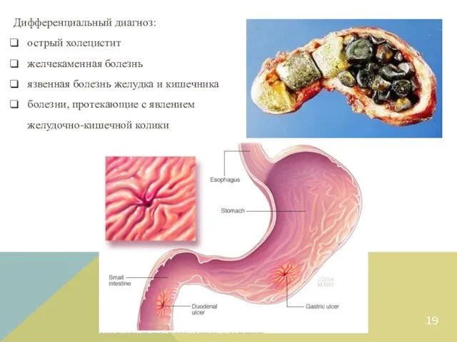 Дифференциальный диагноз: острый холецистит желчекаменная болезнь язвенная болезнь желудка и кишечника