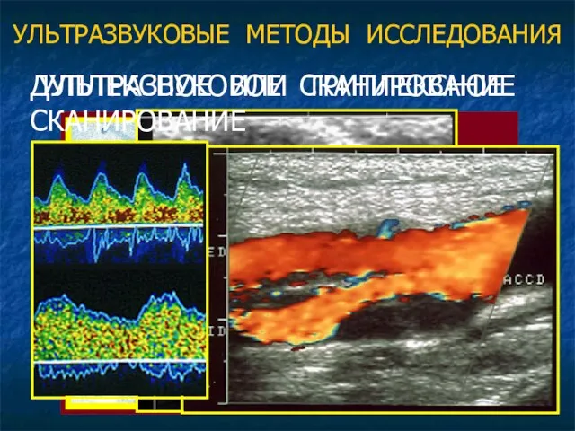 УЛЬТРАЗВУКОВЫЕ МЕТОДЫ ИССЛЕДОВАНИЯ УЛЬТРАЗВУКОВОЕ СКАНИРОВАНИЕ ДУПЛЕКСНОЕ ИЛИ ТРИПЛЕКСНОЕ СКАНИРОВАНИЕ