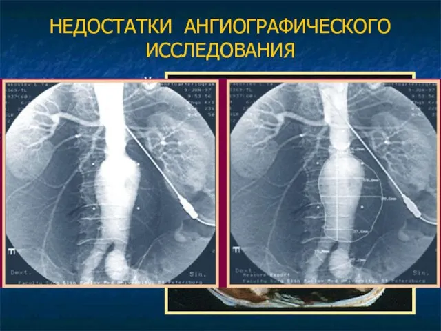 НЕДОСТАТКИ АНГИОГРАФИЧЕСКОГО ИССЛЕДОВАНИЯ 1. Инвазивный метод 2. Необходимость введения контрастного препарата