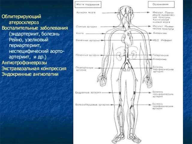 Облитерирующий атеросклероз Воспалительные заболевания (эндартериит, болезнь Рейно, узелковый периартериит, неспецифический аорто-артериит,